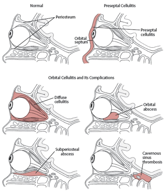 CPG orbital cellulitis image